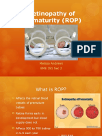 Retinopathy of Prematurity (ROP) : Melissa Andrews BME 281 Sec 2
