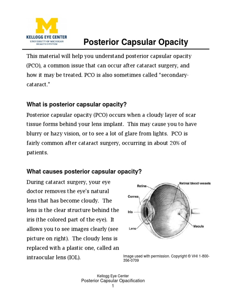 Posterior Capsular Opacity PDF Surgery Clinical Medicine