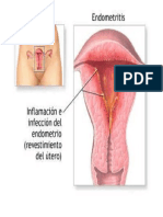 Endometritis Puerperal