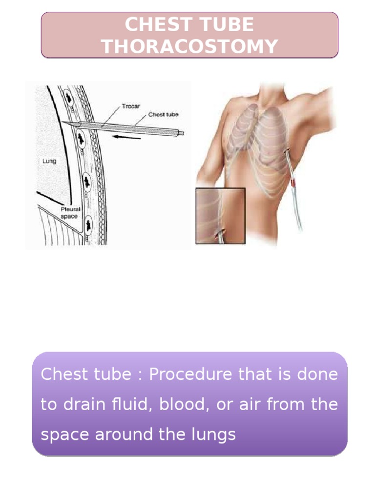Chest Tube Insertion | PDF