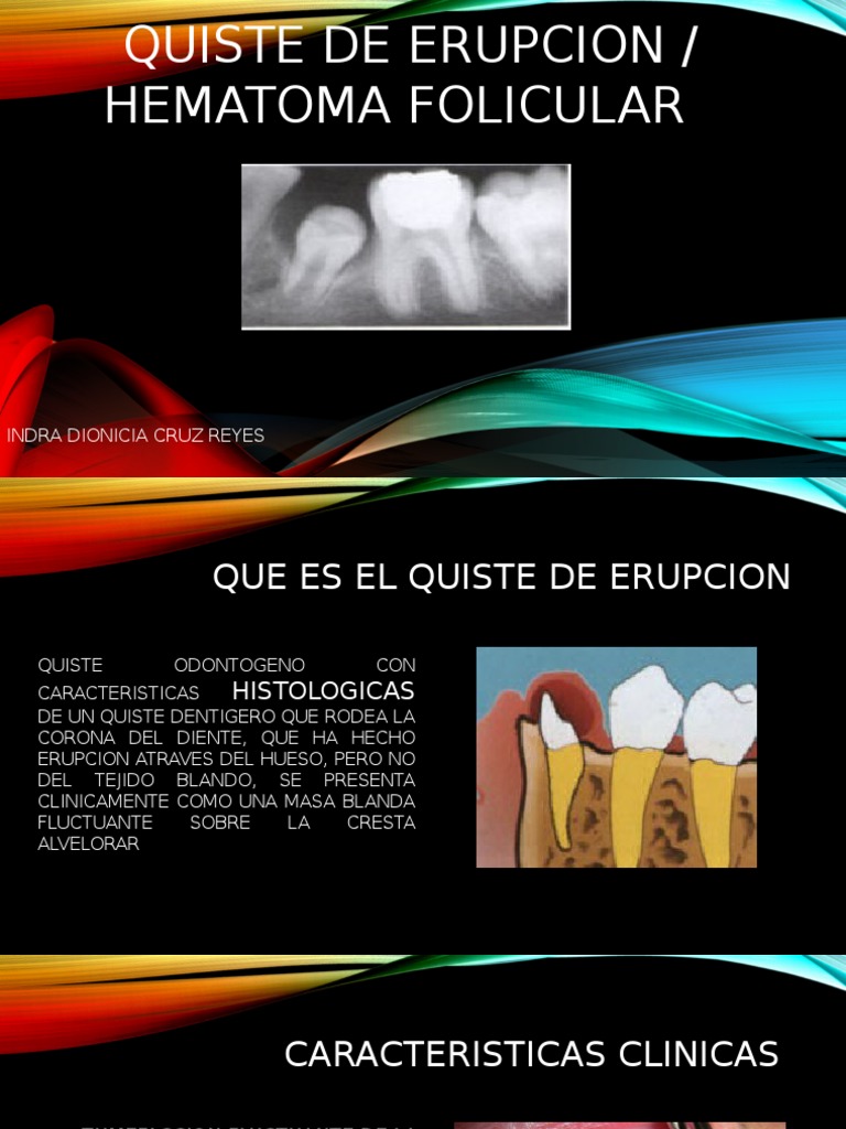 Quiste de Erupción en Niños: Diagnóstico y Tratamiento | PDF | Diente ...