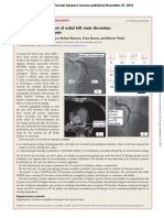 Alexandru Mischie - Successful Management of Ostial Left Main Thrombus by Systemic Thrombolysis