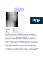 Tibial Plateau Fracture