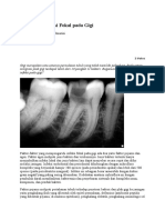 Mencegah Infeksi Fokal Pada Gigi