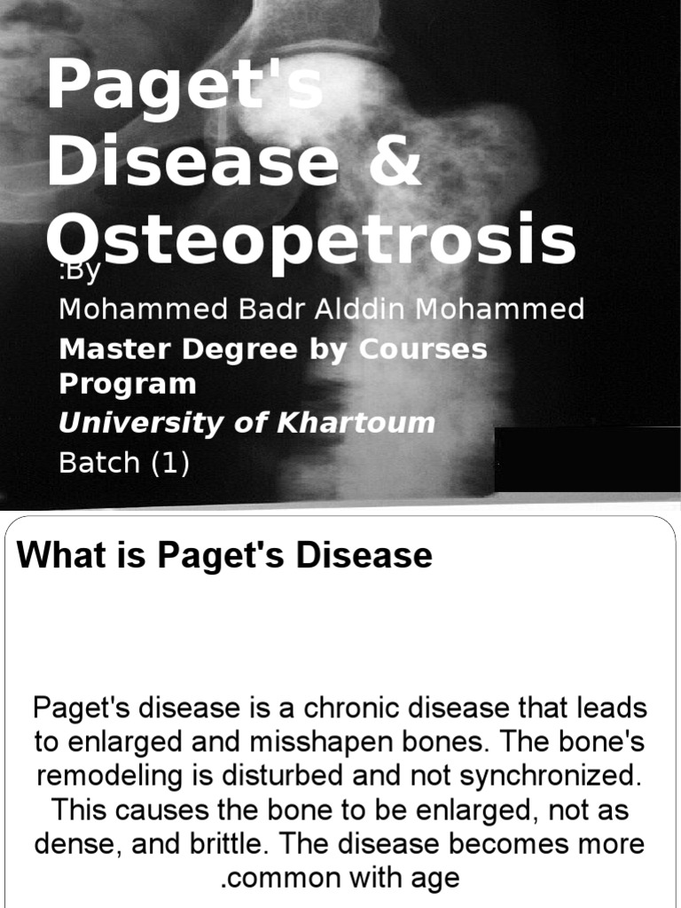 Paget's Disease & Osteopetrosis Assignment Download Free PDF