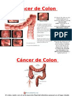 Cáncer de Colon