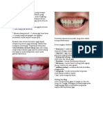 Diastema Itu Adalah Suatu Ruang Yang Terdapat Diantara Dua Buah Gigi Yang Berdekatan Yang Terjadi Karena Ketidaksesuaian Antara Lengkung Gigi Dengan Lengkung Rahang