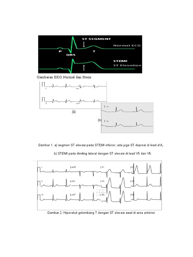 Gambaran EKG pada STEMI dan Normal | PDF