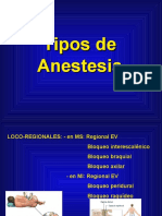 Tipos de Anestesia