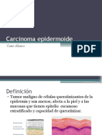 Carcinoma Epidermoide