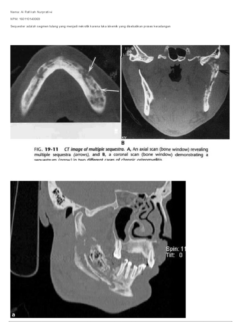 Sequester dan Osteomyelitis Mandibula | PDF | Sains & Matematika