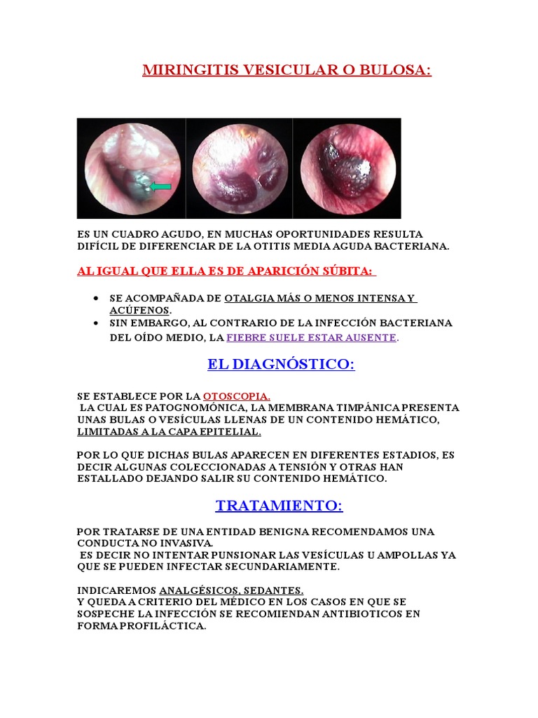 Miringitis Bullosa y Calcificaciones Tímpanicas | PDF