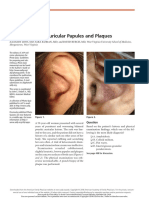 Papulas y Placas Pruriginosas Bialteral Auricular