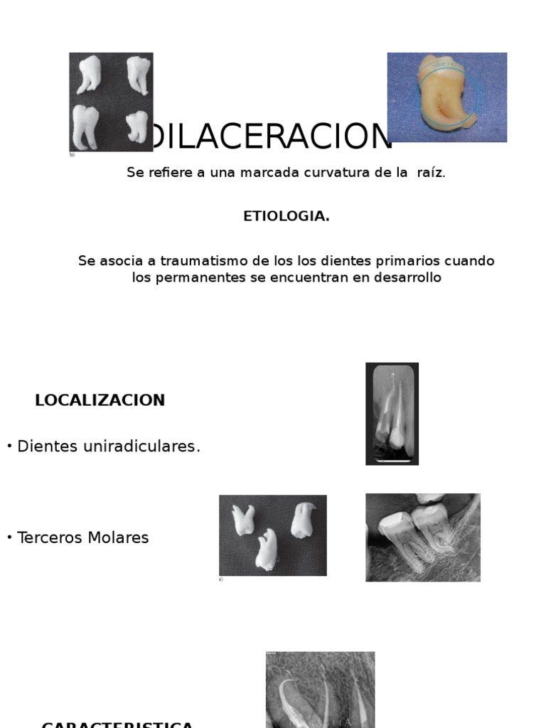 Dilaceración y Concresencia Dental | PDF