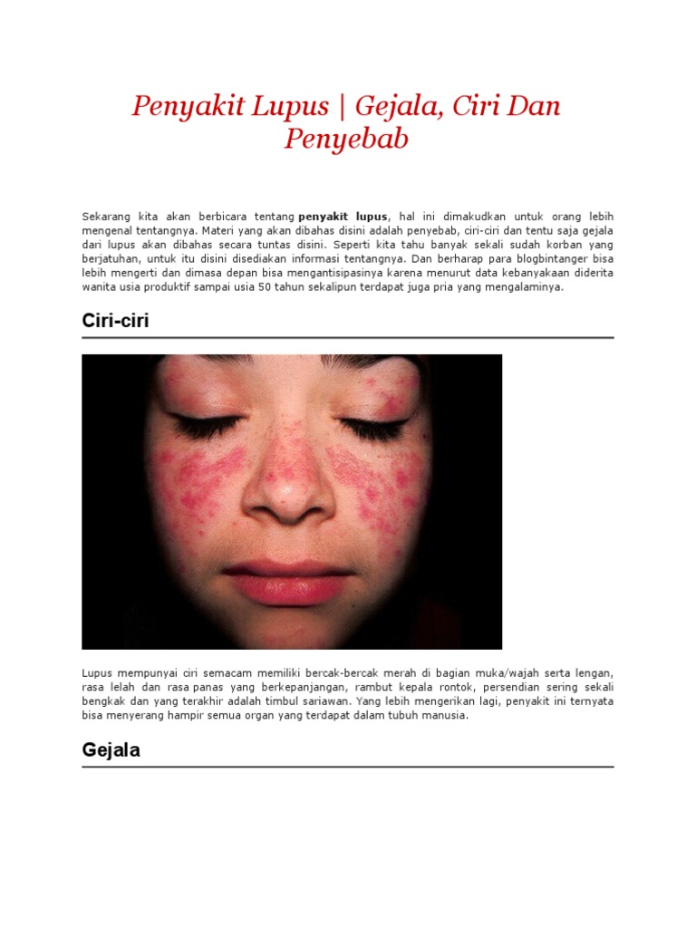 Penyakit Lupus