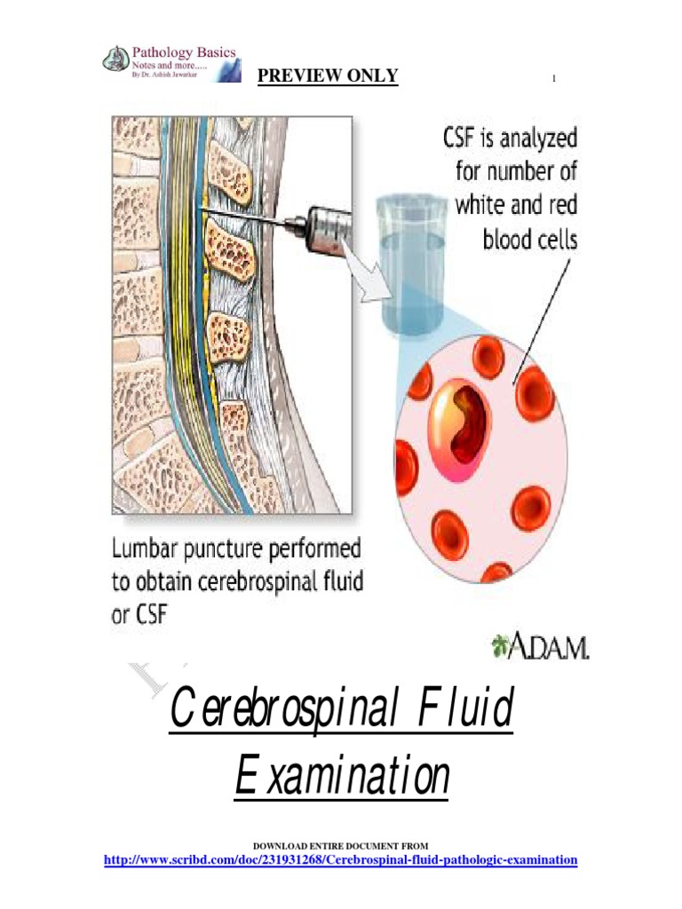 Cerebrospinal Fluid Examination: Preview Only | Meningitis ...