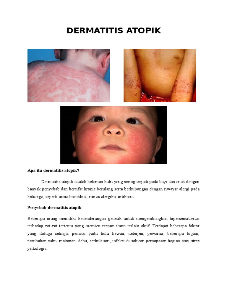 Panduan Dermatitis Atopik pada Anak | PDF | Pengembangan Diri ...