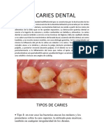 La Caries Dental