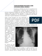 Calcificacion Pulmonar Asociada A Una Insuficencia Renal Cronica