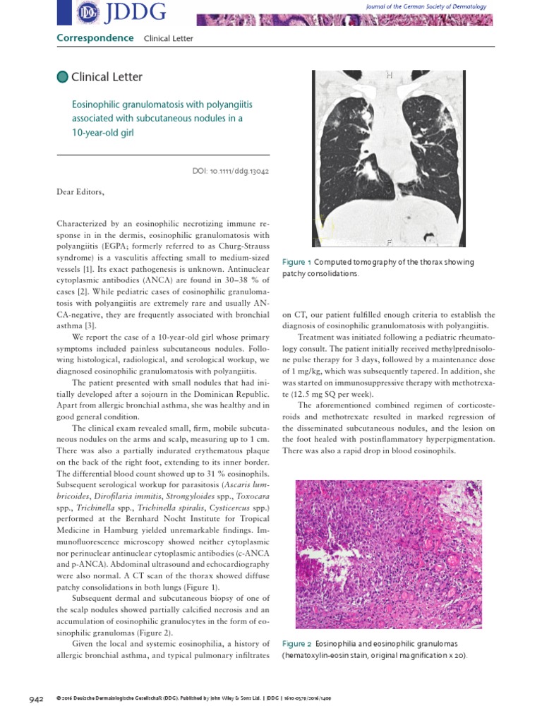 Eosinophilic Granulomatosis With Polyangiitis Associated With ...