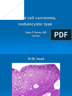  Basal Cell Carcinoma, Nodulocystic Type. M 58, Head. 