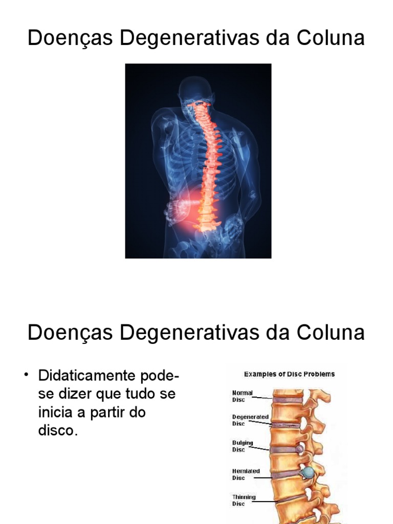 Doenças Degenerativas da Coluna crm