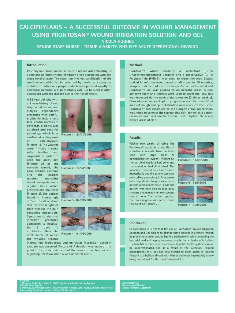 Calciphylaxis a Successful in Wound Management Cutaneous