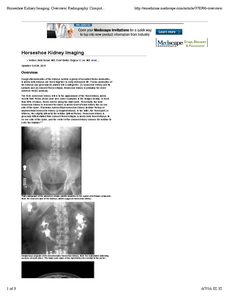Horseshoe Kidney Imaging Overview, Radiography, Computed Tomography