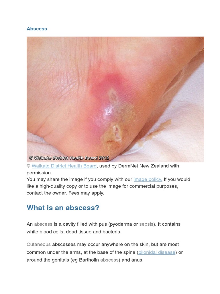 Abscess Infection Public Health