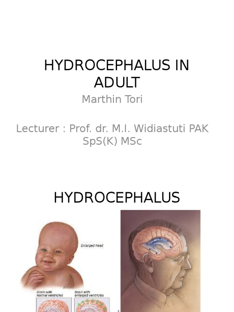 Hydrocephalus in Adult Present | Download Free PDF | Cerebrospinal ...