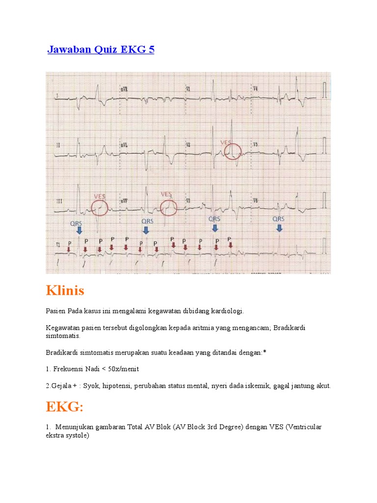 Download 94+ Gambar Ekg Gagal Jantung Paling Bagus Gratis HD