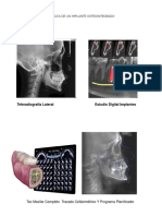 Planificacion Quirurgica de Un Implante Osteointegrado