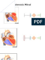 Estenosis Mitral