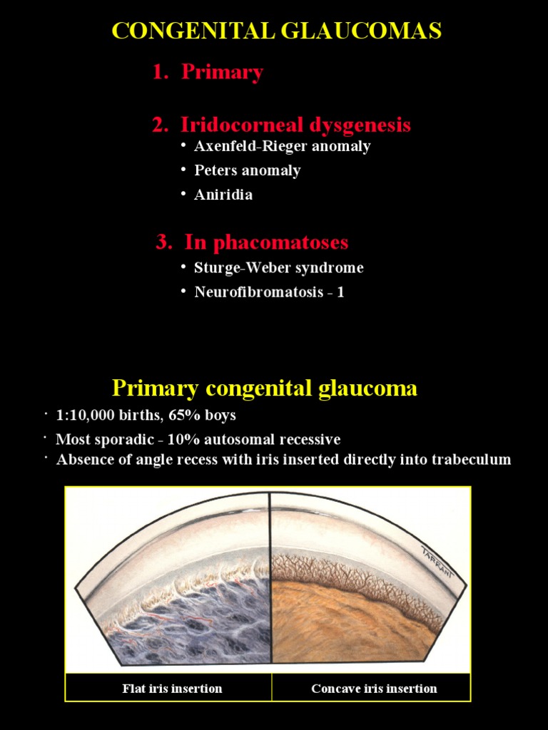Congenital Glaucomas: 1. Primary 2. Iridocorneal Dysgenesis | PDF