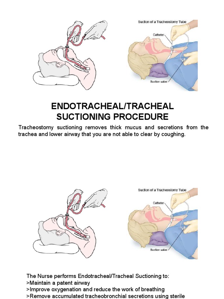 Endotracheal Suctioning Procedure Clinical Medicine Respiratory System