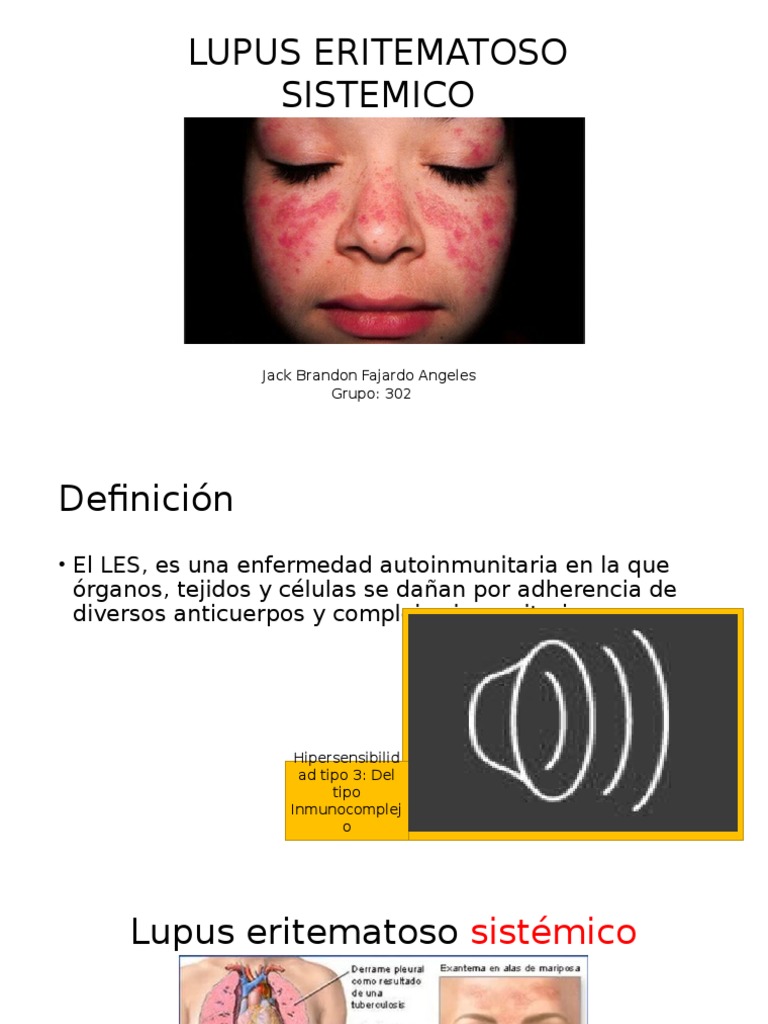 Lupus Eritematoso Sistemico Lupus Eritematoso Sistemico