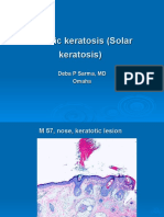 Actinic Keratosis (Solar Keratosis) - M 57, Nose