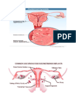 Tugas Gambar Endometriosis