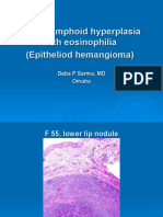  Angiolymphoid Hyperplasia With Eosinophilia., F 55, Lower Lip. 