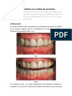 Mejora Estética Con Carillas de Porcelana