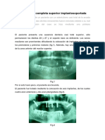 Prótesis Fija Completa Superior Implantosoportada