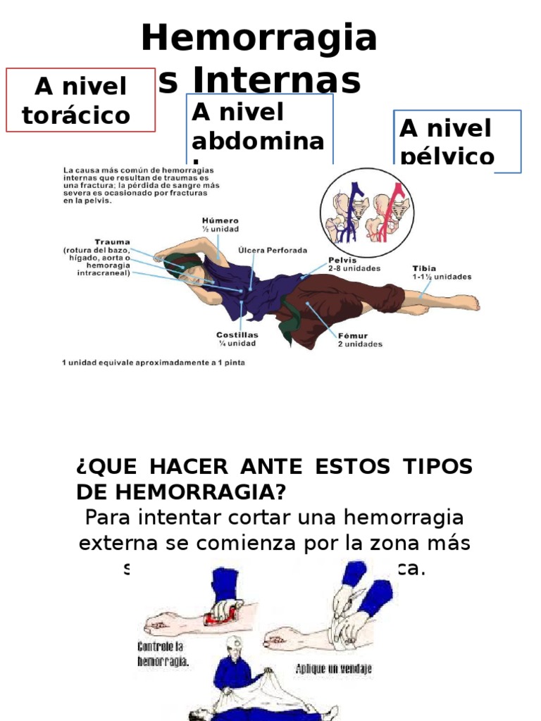 Hemorragia s Internas: A nivel torácico A nivel abdomina l A nivel pélvico