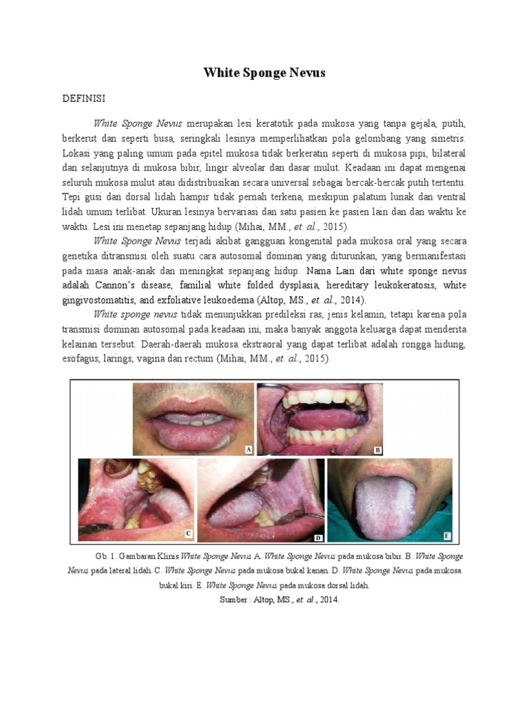 Definisi White Sponge Nevus