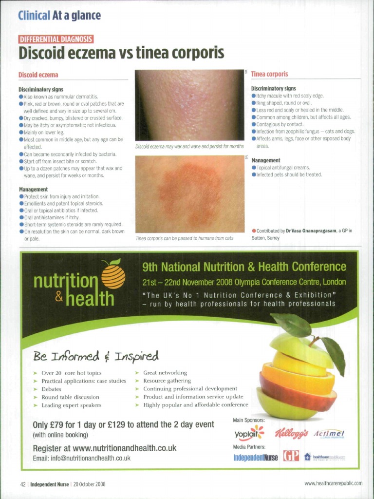 Discoid Eczema Vs Tinea Corporis Nutritio PDF