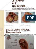 Bolile Valvei Mitrale - Stenoza Mitrala