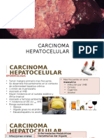 Carcinoma Hepatoca