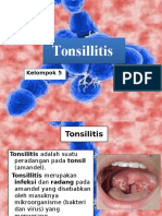 Tonsillitis