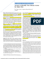 Optic Nerve Edema vs Pseudoedema