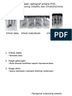 Perbedaan Radiograf Antara POD, Periapikal Sclerosing Osteitis dan Enotosis/none dense island