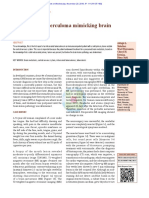 Tuberculoma Brain Metastatic